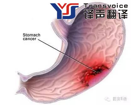 医学翻译：消化科——胃癌(图1)