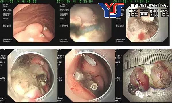 医学翻译：消化科——胃癌(图7)